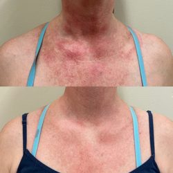 The Refined 209 - After just one chemical peel