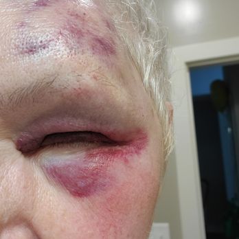 Chippenham Hospital - My swollen eye. As it healed. It remained bloodshot - Hospitals Near Me - Richmond, Virginia