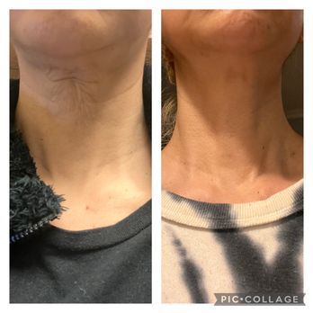 Cindy Ha - Microcurrent Facial
(Jan 2023- October 2023)
80 min Facial Every 2 weeks
Photo is not Edited - Makeup Artists Near Me - Los Angeles, California Cindy Ha - Microcurrent Facial
(Jan 2023- October 2023)
80 min Facial Every 2 weeks
Photo is not Edited - Makeup Artists Near Me - Los Angeles, California