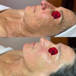 New Needle Free Filler Facial