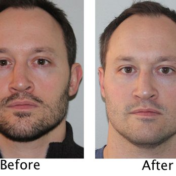 Garrett H Bennett, MD - Boxer with severe deviated septum after nasal surgery - Ear Nose & Throat Near Me - New York, New York Garrett H Bennett, MD - Boxer with severe deviated septum after nasal surgery - Ear Nose & Throat Near Me - New York, New York