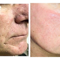PRANA Skincare Clinic - Laser Skin Tightening