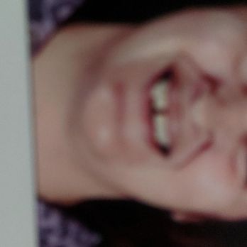 Smart Smile Dental - The gap has only got worse $44,000.00 dollar fix. Money I don't have. - General Dentistry Near Me - Orange, California