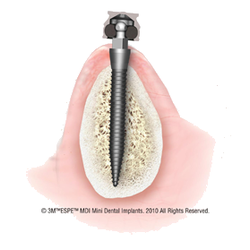 Aronda Jones, DDS - Now Placing Mini Dental Implants in Salisbury MD