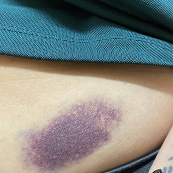 Screaming Eagle Mountain Coaster at Ruidoso Winter Park - The bruise from the sudden stop - Amusement Parks Near Me - Alto, New Mexico
