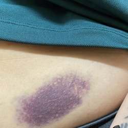 Screaming Eagle Mountain Coaster at Ruidoso Winter Park - The bruise from the sudden stop