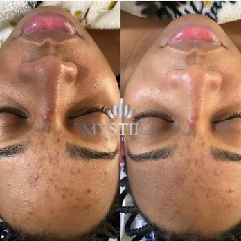 Mystika Beauty - Deluxe Facial With Microdermabrasion - Medical Spas Near Me - Sunrise, Florida Mystika Beauty - Deluxe Facial With Microdermabrasion - Medical Spas Near Me - Sunrise, Florida