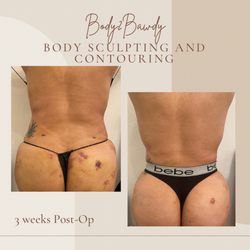 3 Weeks Post Op Massage Results