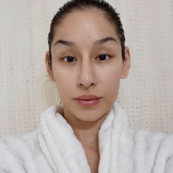 Ageless MD - 7 days after 1 vial of Sculptra was used (pic,. Number 2, 03/07) - Medical Spas Near Me - Tustin, California Ageless MD - 7 days after 1 vial of Sculptra was used (pic,. Number 2, 03/07) - Medical Spas Near Me - Tustin, California