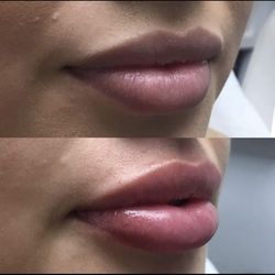 Beautiful pouty lips using Juvederm