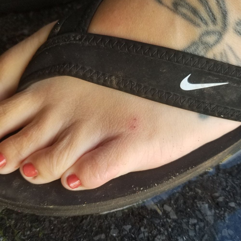 Toe nails are painfully shrort, I have a cut on the top of my foot and scrapes on the back of my heel. Recept to prove. Toe nails are painfully shrort, I have a cut on the top of my foot and scrapes on the back of my heel. Recept to prove.