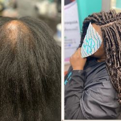 Hair loss replacement with Crochet Braids
