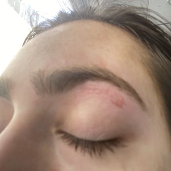 My Brows - burned skin - Threading Services Near Me - New York, New York My Brows - burned skin - Threading Services Near Me - New York, New York