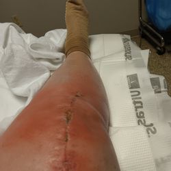 Delray Orthopaedic Center - DELRAY LEFT ME UNATTENDED FOR OVER 16 HRS. WORST EXPERIENCE EVER