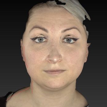 Cory Torgerson - 3D imagining- distorted face.   Wider neck  Wider face - Ear Nose & Throat Near Me - Toronto, Ontario
