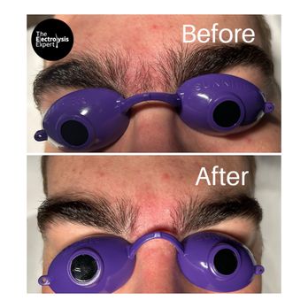 The Electrolysis Expert - Hair Removal Near Me - San Diego, California The Electrolysis Expert - Hair Removal Near Me - San Diego, California
