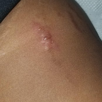 Electrik Image Spa - burned by Sculpsure machine - Day Spas Near Me - Lincoln Park, Michigan