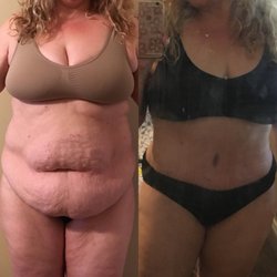 Rowley Plastic Surgery - Abdominoplasty front view (5 weeks postop)