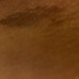 This is a photo of what some of the bruising looks like This is a photo of what some of the bruising looks like