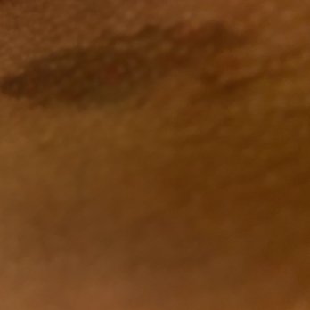 Senses Beauty Lounge - This is a photo of what some of the bruising looks like - Skin Care Near Me - Miami, Florida Senses Beauty Lounge - This is a photo of what some of the bruising looks like - Skin Care Near Me - Miami, Florida