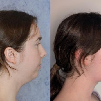 Sagar Patel Aesthetics - Chin implant - Cosmetic Surgeons Near Me - Beverly Hills, California Sagar Patel Aesthetics - Chin implant - Cosmetic Surgeons Near Me - Beverly Hills, California