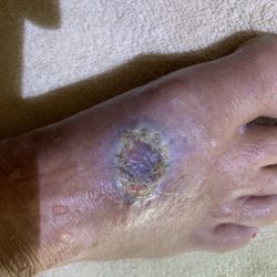 Innovative Dermatology and Mohs Surgery - Infected look