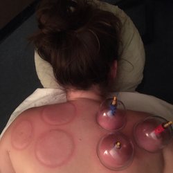 Amelia Comolli, LMT - Cupping!