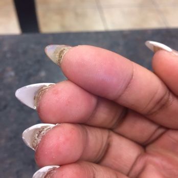 Royal Nails Spa - Infected nails - Nail Salons Near Me - Sunrise, Florida Royal Nails Spa - Infected nails - Nail Salons Near Me - Sunrise, Florida