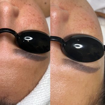 Simple Skincare Laser & Spa - Laser Hair Removal Near Me - Houston, Texas Simple Skincare Laser & Spa - Laser Hair Removal Near Me - Houston, Texas