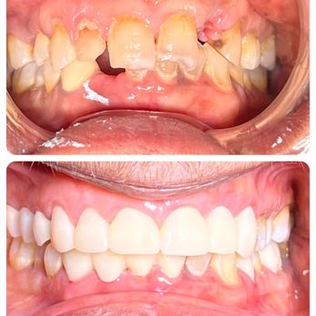 Modesto Dentistry And Implants - Smile Makeover with Cosmetic Crowns and Bridges - General Dentistry Near Me - Modesto, California Modesto Dentistry And Implants - Smile Makeover with Cosmetic Crowns and Bridges - General Dentistry Near Me - Modesto, California