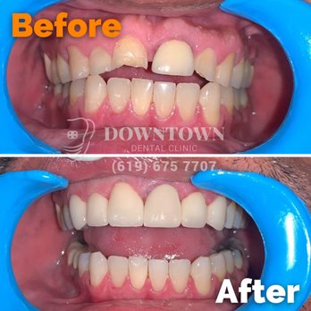 Downtown Dental Tijuana - Before and After with Crowns - Cosmetic Dentists Near Me - Tijuana, BCN Downtown Dental Tijuana - Before and After with Crowns - Cosmetic Dentists Near Me - Tijuana, BCN