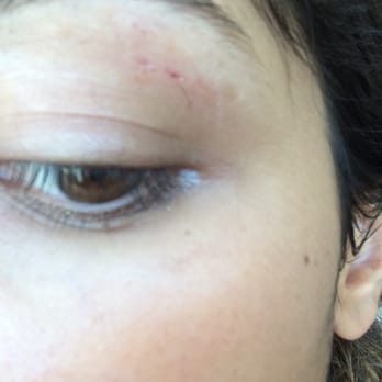 Epilab - Cuts from the angry employee. I did not deserve this for gently explaining how I want my eyebrows. - Hair Removal Near Me - Montreal, Quebec Epilab - Cuts from the angry employee. I did not deserve this for gently explaining how I want my eyebrows. - Hair Removal Near Me - Montreal, Quebec