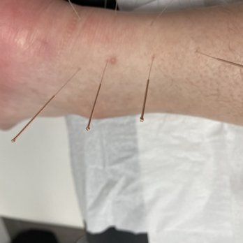 NuvoMed - Acupuncture for Achilles Tendon Pain. - Acupuncture Near Me - Montreal, Quebec NuvoMed - Acupuncture for Achilles Tendon Pain. - Acupuncture Near Me - Montreal, Quebec