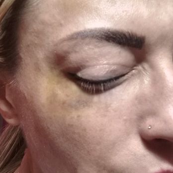 Peachy Grand Central - Photo of bruise approximately 10 days into healing and still significant. - Medical Spas Near Me - New York, New York