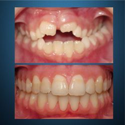 Dr. Dona Seely Orthodontics - TREATED IN 3 PLANES.
TX: Palatal expander, 1st Phase to Make Room for Canines, Full Treatment