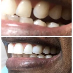 Badr Dental - Dr. B fixed this in 30 minutes, when other dentists stated it could not be done, HE IS THE FIXER!