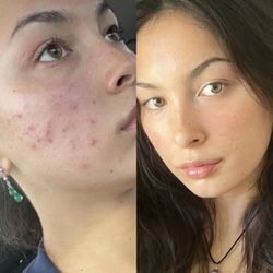 Bella Skincare Solutions - Before and afters