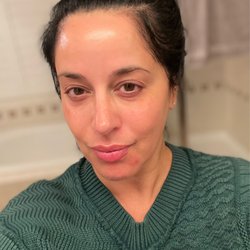 Skin Lab & Contour - 3 months after 2nd treatment