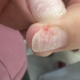 My bleeding ripped off nail