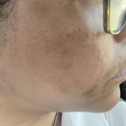 Dark spot on my face appeared after peel.