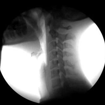 Bellevue Chiropractic - Cervical Video Fluoroscopy - Chiropractors Near Me - Bellevue, Washington