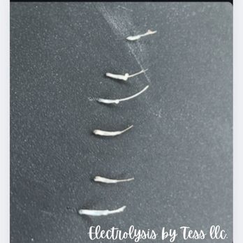 Electrolysis By Tess - Hair Removal Near Me - Aiken, South Carolina Electrolysis By Tess - Hair Removal Near Me - Aiken, South Carolina