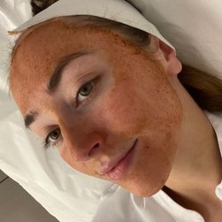 Skinney Medspa & Coolsculpting - Chemical peel