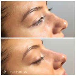 EverYoung Medical Aesthetics - Non surgical nose job. Correcting dorsal hump with dermal fillers.