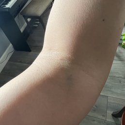 When you're getting your blood drawn and already know this is gonna bruise...here's a pic 3 hrs after. When you're getting your blood drawn and already know this is gonna bruise...here's a pic 3 hrs after.