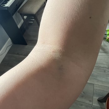 Quest Diagnostics - When you're getting your blood drawn and already know this is gonna bruise...here's a pic 3 hrs after. - Laboratory Testing Near Me - Huntington Beach, California Quest Diagnostics - When you're getting your blood drawn and already know this is gonna bruise...here's a pic 3 hrs after. - Laboratory Testing Near Me - Huntington Beach, California