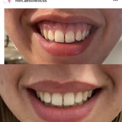 MM Aesthetics: Marina Musalyants, RN, MSN - Botox for gummy smile