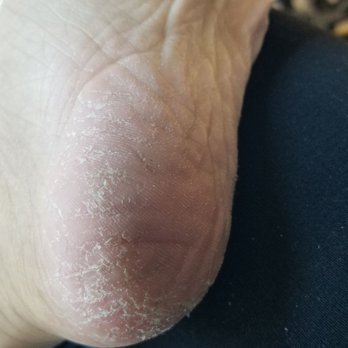Queen Spa - my foot AFTER the pedicure. still crusty and rough. very disappointed - Skin Care Near Me - Austin, Texas