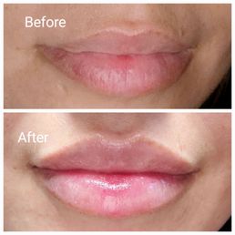 Lips today! Juv Ultra