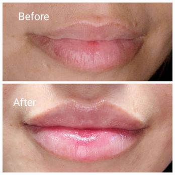 B Beautiful Med Spa - Lips today! Juv Ultra - Laser Hair Removal Near Me - Laguna Hills, California